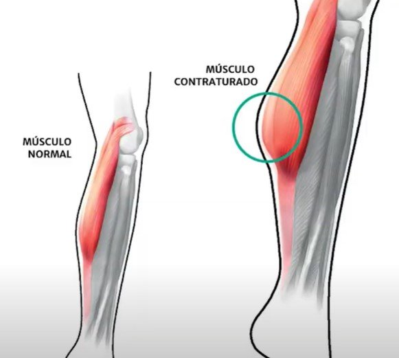 Distens es Musculares Contraturas Musculares E Outras Les es Distens es Musculares Contraturas Musculares E Outras Les es