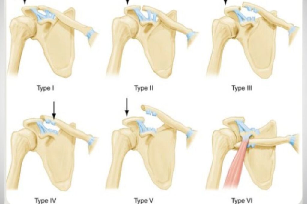 tipos-luxacao-acromioclavicular-dr-eric-curi-ortopedista-ombro-cotovelo-são-paulo