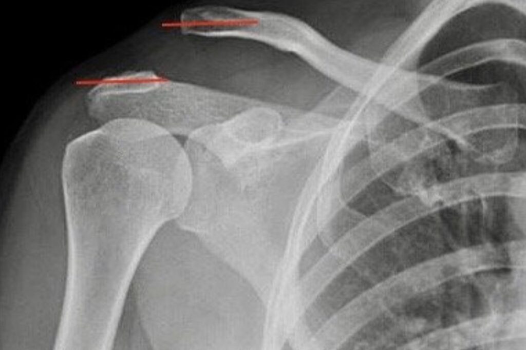 diagnostico-luxacao-acromioclavicular-dr-eric-curi-ortopedista-ombro-cotovelo-são-paulo