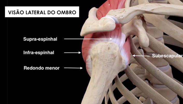 tendinite-calcaria-supraespinhal-dr-eric-curi-ortopedista-ombro-cotovelo-sao-paulo
