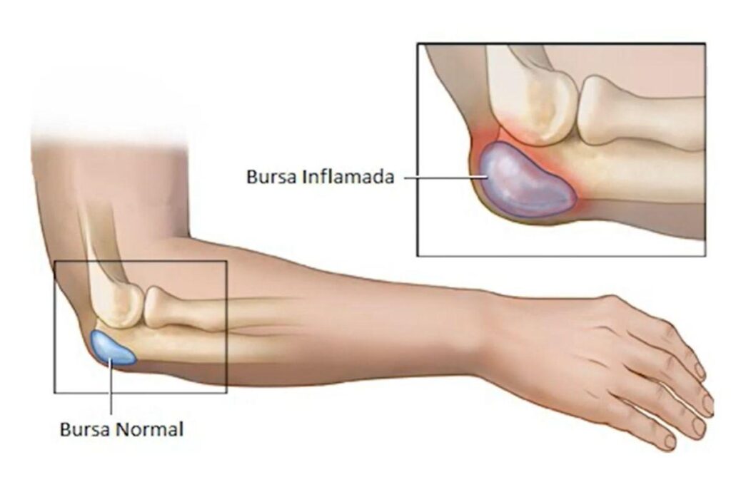 bursa-cotovelo-dr-eric-curi-ortopedista-cotovelo-sao-paulo