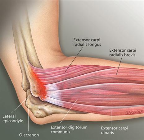 epicondilite-lateral-dr-eric-curi-ortopedista-sp