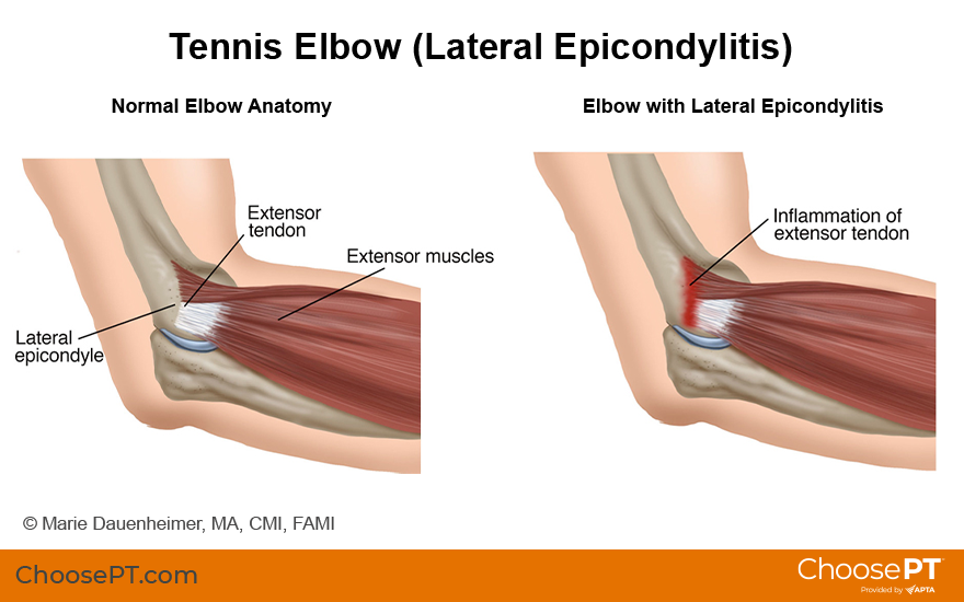 inflamacao-cotovelo-dr-eric-curi