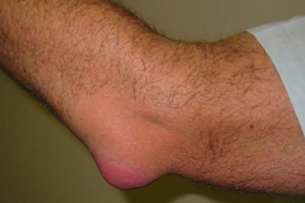 inflamacao-cotovelo-dr-eric-curi-ortopedista-cotovelo-sao-paulo