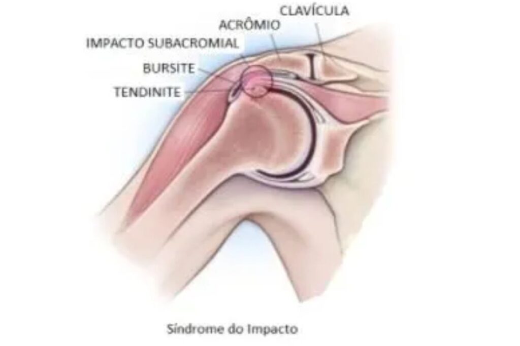 sindrome-do-impacto-no-ombro-sintomas-dr-eric-curi-ortopedista-ombro-cotovelo-sao-paulo