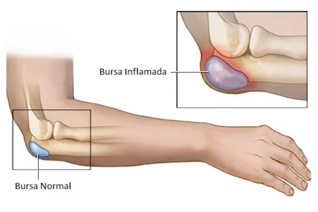 bursite-no-cotovelo-sintomas-dr-eric-curi-ortopedista-ombro-cotovelo-sao-paulo