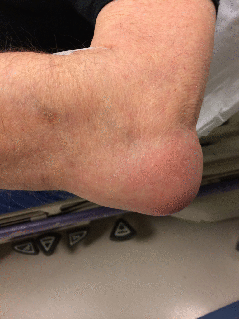 bursite-infeccao-cotovelo-dr-eric-curi-sp