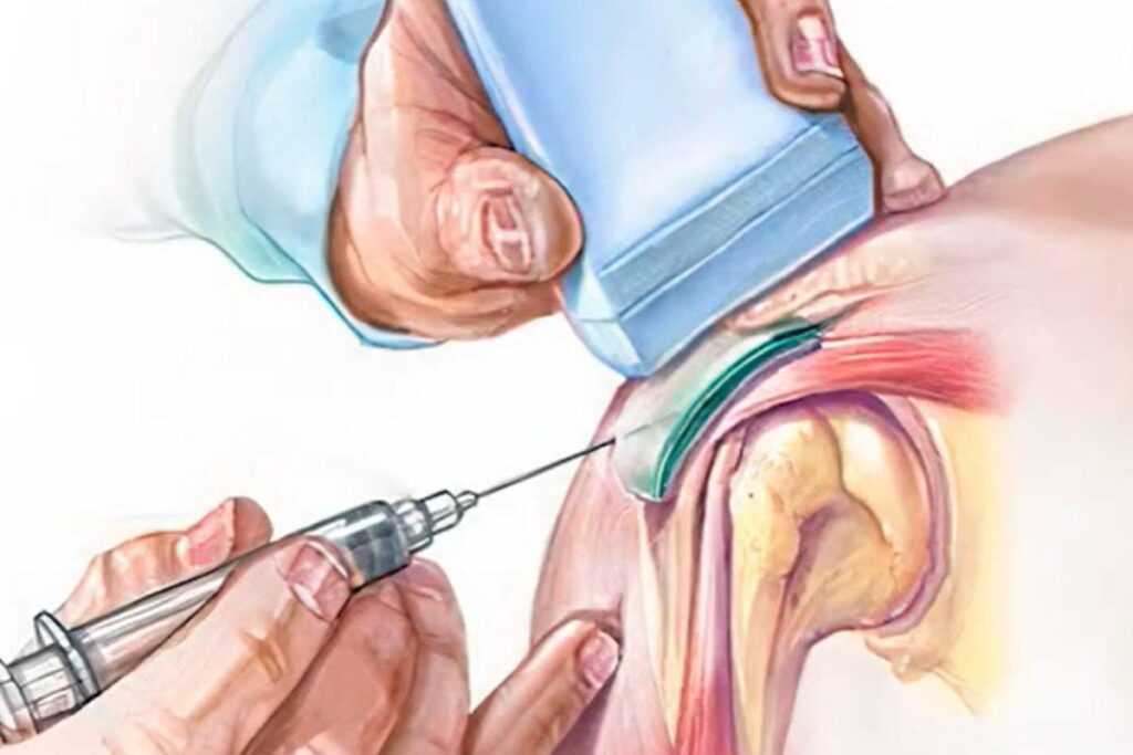 procedimento-ombro-dr-eric-curi-ortopedista-ombro-cotovelo-sao-paulo