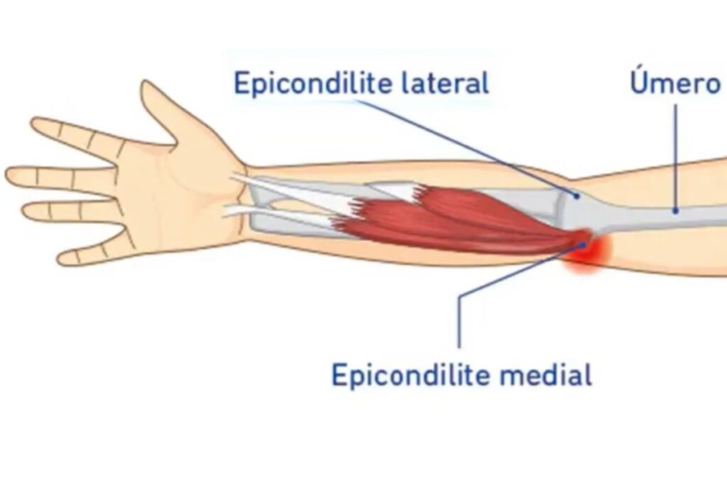 epicondilite-medial-dr-eric-curi-ortopedista-ombro-cotovelo-são-paulo