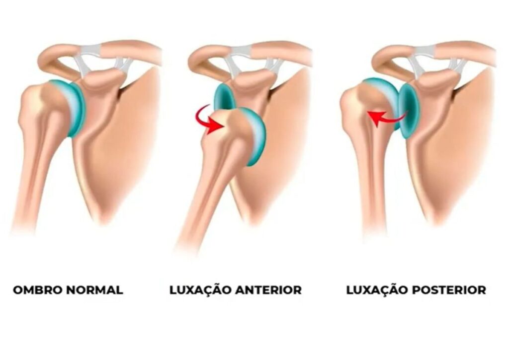 lesao-de-bankart-causas-dr-eric-curi-ortopedista-ombro-cotovelo-são-paulo