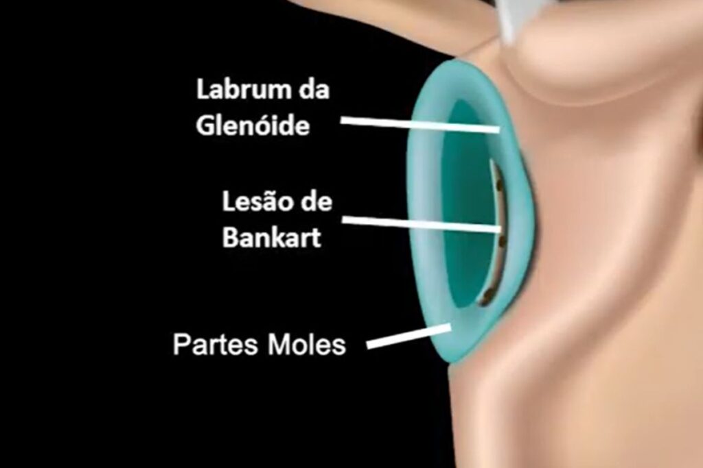 lesao-de-bankart-sintomas-dr-eric-curi-ortopedista-ombro-cotovelo-são-paulo