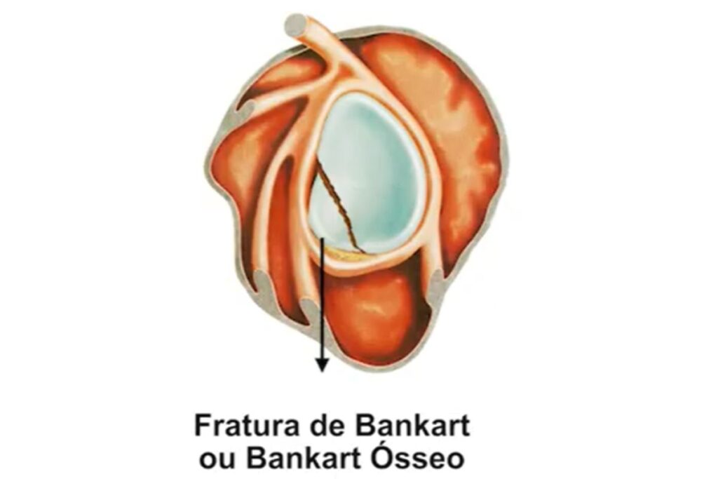 lesao-de-bankart-tipos-dr-eric-curi-ortopedista-ombro-cotovelo-são-paulo