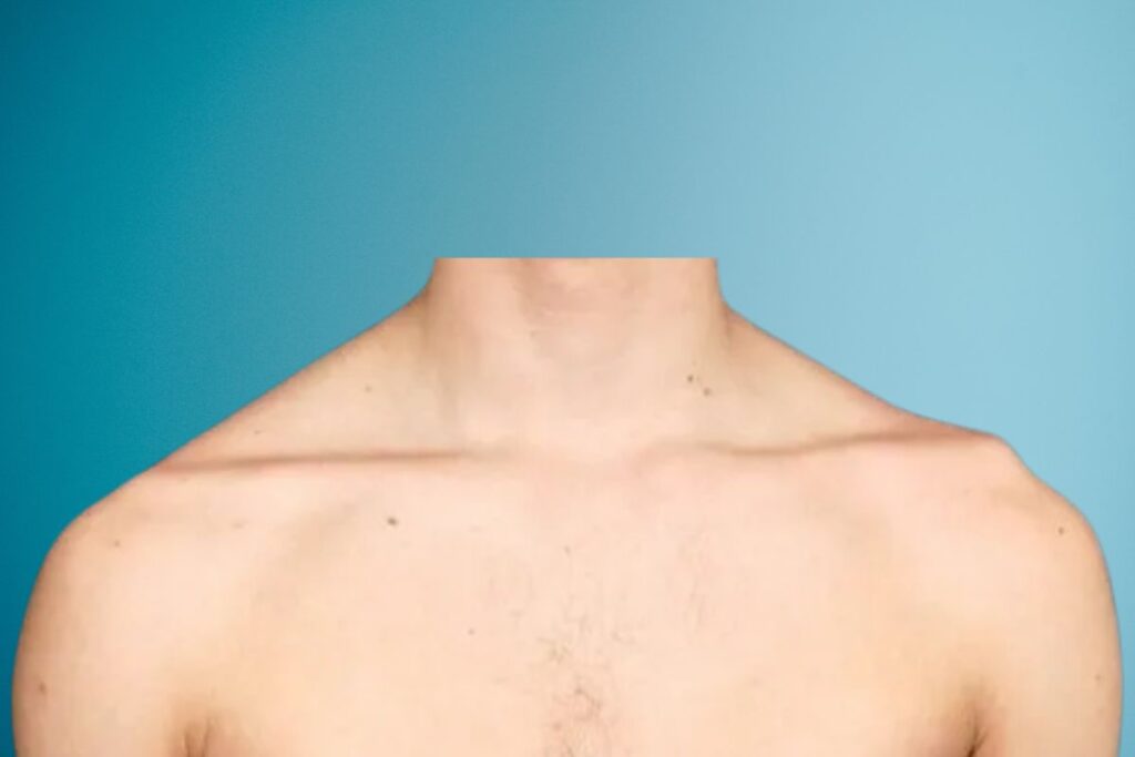 luxacao-acromioclavicular-sintomas-dr-eric-curi-ortopedista-ombro-cotovelo-sao-paulo