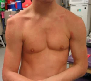 Ombro deslocado: como proceder?