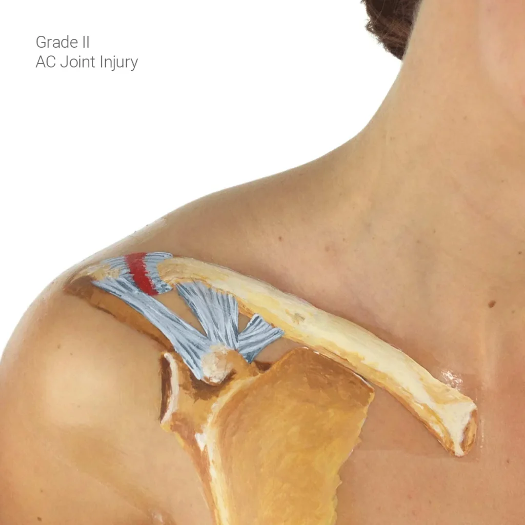 ombro-luxado-dr-eric-curi-ortopedista-ombro-cotovelo-sao-paulo