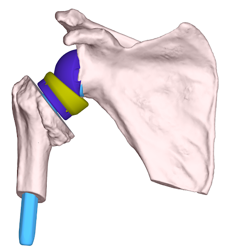 protese-no-ombro-ortopedista-sao-paulo