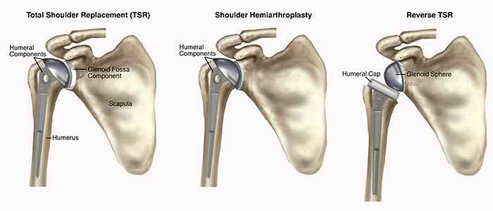 sindrome-do-manguito-rotador-dr-eric-curi-ortopedista