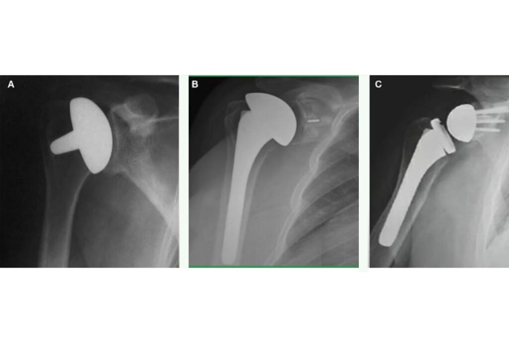 tipos-protese-ombro-dr-eric-curi-ortopedista-ombro-cotovelo-são-paulo
