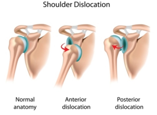 tratamento-ombro-deslocado-dr-eric-curi-ortopedista-ombro-cotovelo-sao-paulo