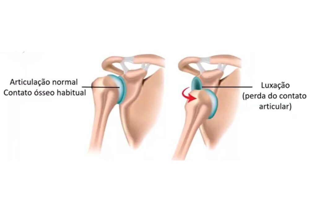instabilidade-no-ombro-dr-eric-curi-ortopedista-ombro-cotovelo-são-paulo