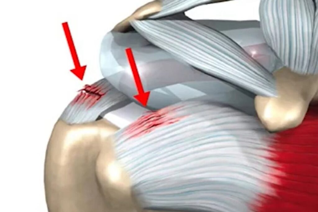 lesao-parcial-manguito-rotador-sintomas-dr-eric-curi-ortopedista-ombro-cotovelo-sao-paulo