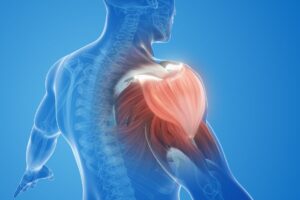 Lesão total do manguito rotador: saiba mais