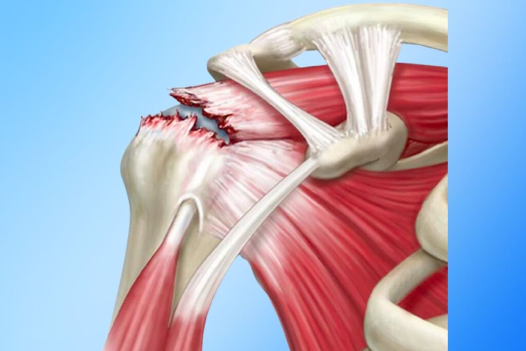 lesao-total-manguito-rotador-sintomas-dr-eric-curi-ortopedista-ombro-cotovelo-sao-paulo