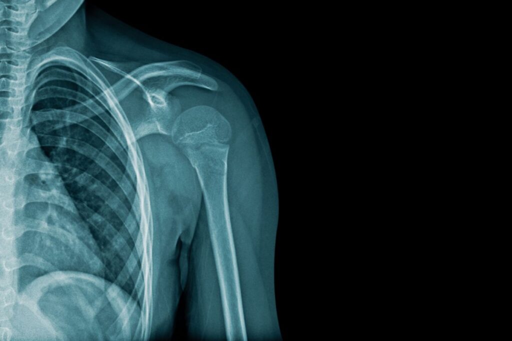 ombro-estalando-diagnostico-dr-eric-curi-ortopedista-ombro-cotovelo-são-paulo