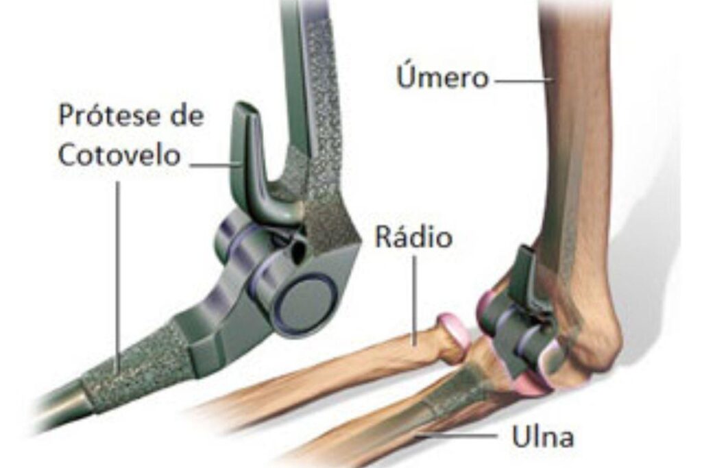 cirurgia-cotovelo-dr-eric-curi-ortopedista-cotovelo-sao-paulo