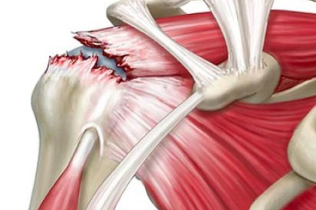 cirurgia-manguito-rotador-beneficios-dr-eric-curi-ortopedista-ombro-cotovelo-sao-paulo