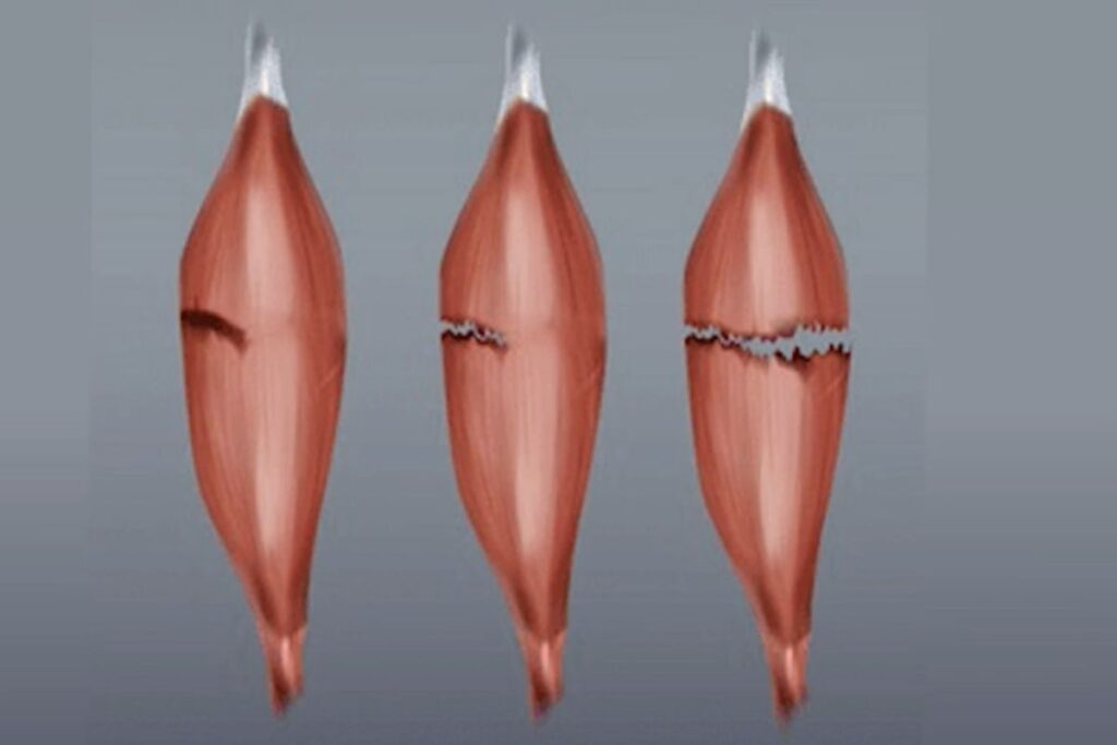 distensao-muscular-sintomas-dr-eric-curi-ortopedista-ombro-cotovelo-sao-paulo